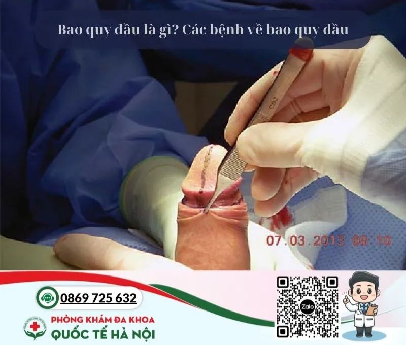 Bao quy đầu là gì?