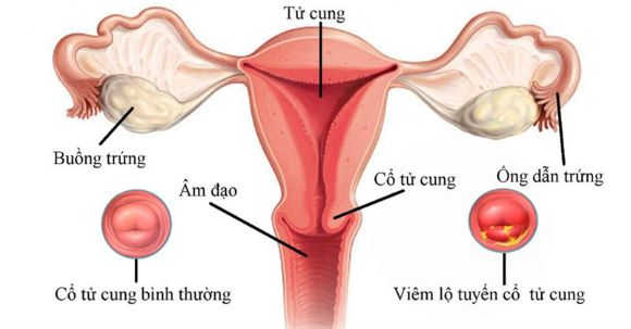 các bệnh thường gặp ở cổ tử cung nữ giới, viêm cổ tử cung