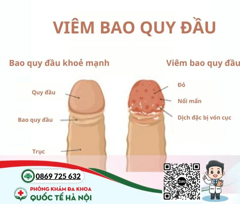 Các bệnh về bao quy đầu