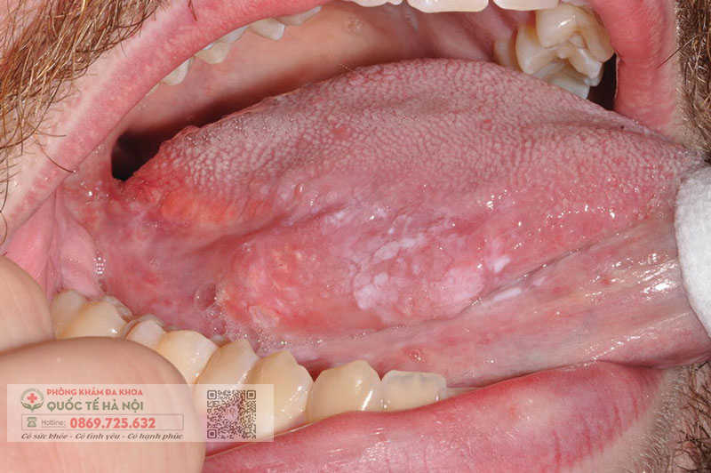 hình ảnh bệnh sùi mào gà ở miệng ở mồm 152 xã đàn