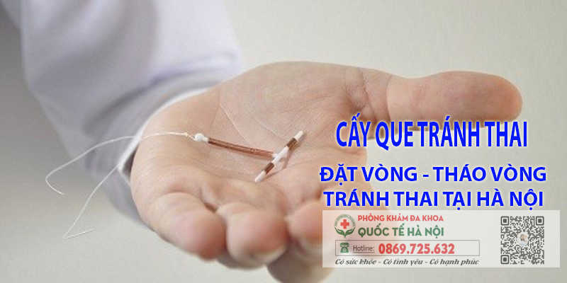 cấy que đặt vòng tránh thai