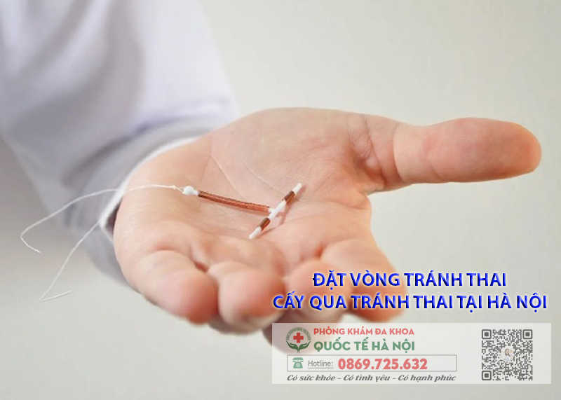 Đặt vòng tránh thai: một biện pháp tránh thai an toàn