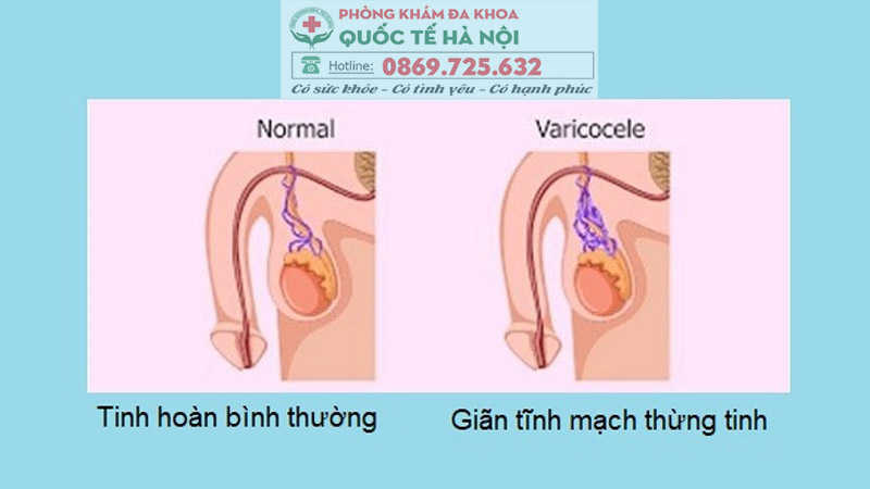 giãn tĩnh mạch thừng tinh là gì