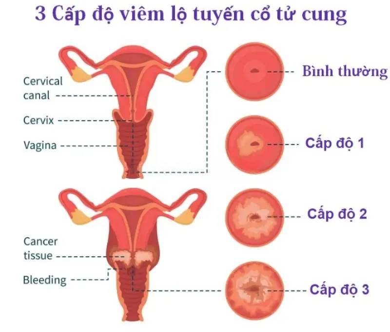 Các cấp độ của viêm lộ tuyến cổ tử cung