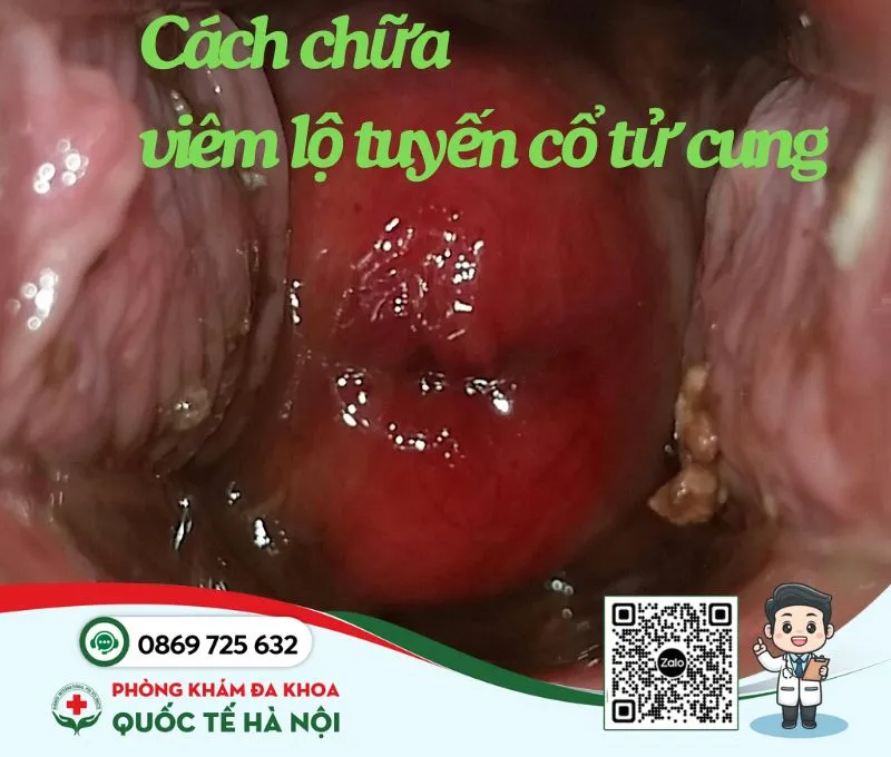 Các cách chữa viêm lộ tuyến cổ tử cung