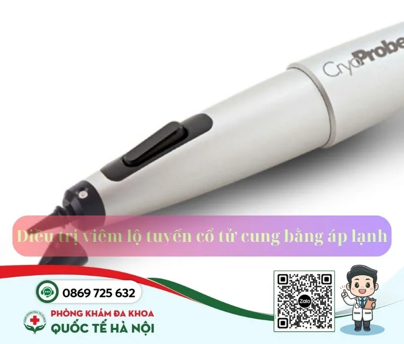 Điều trị viêm lộ tuyến cổ tử cung bằng áp lạnh