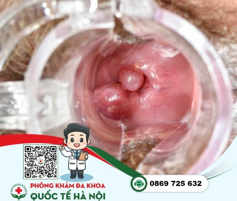 Bệnh phụ khoa polyp cổ tử cung