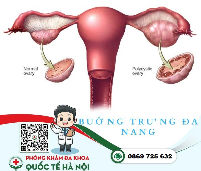 Bệnh phụ khoa buồng trứng đa nang