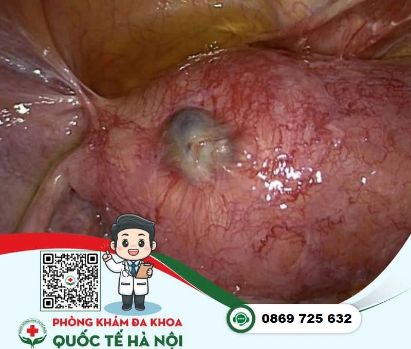 Bệnh phụ khoa lạc nội mạc tử cung adenomyosis