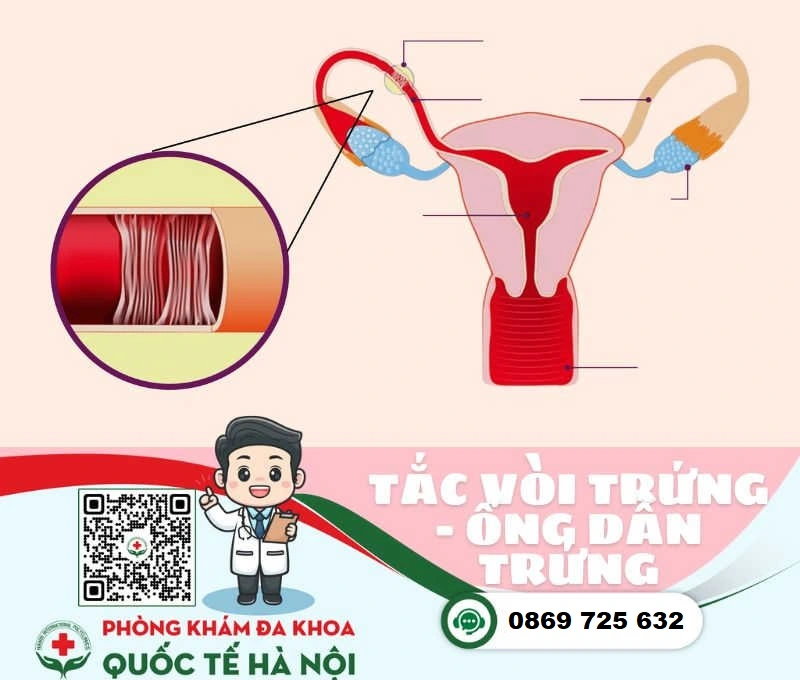 Bệnh phụ khoa tắc vòi trứng