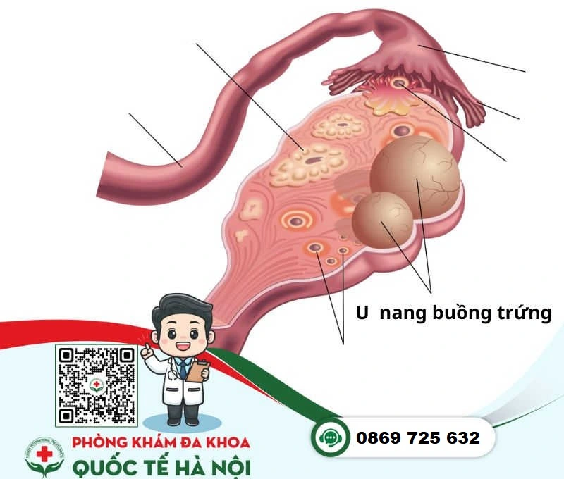 Bệnh phụ khoa u nang buồng trứng có thể gây vô sinh