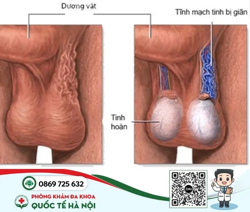 Bệnh nam khoa giãn tĩnh mạch thừng tinh