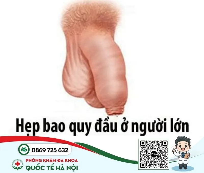 Bệnh nam khoa hẹp bao quy đầu