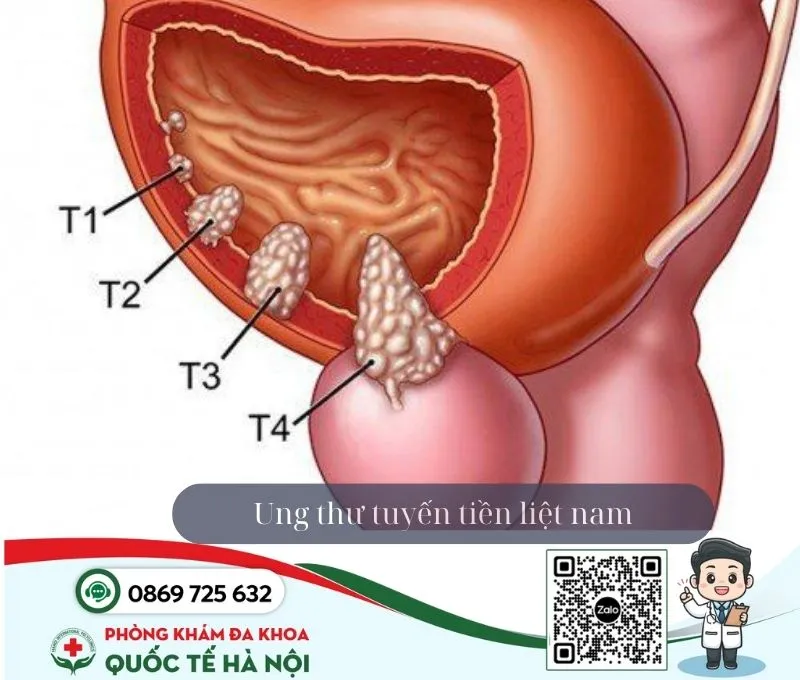 Bệnh nam khoa ung thư tuyến tiền liệt