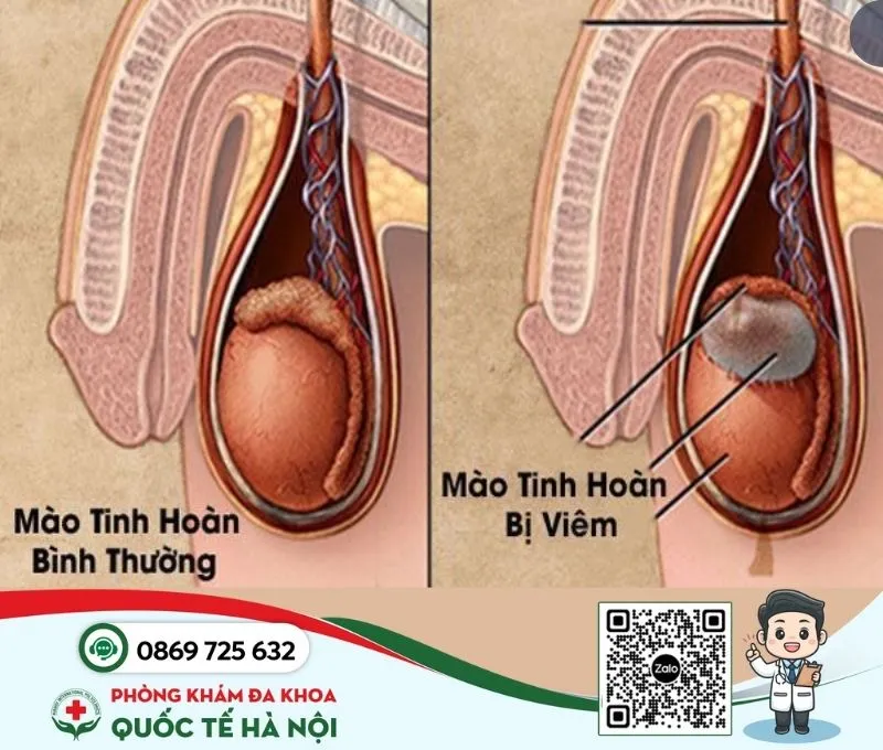 Bệnh nam khoa viêm mào tinh hoàn