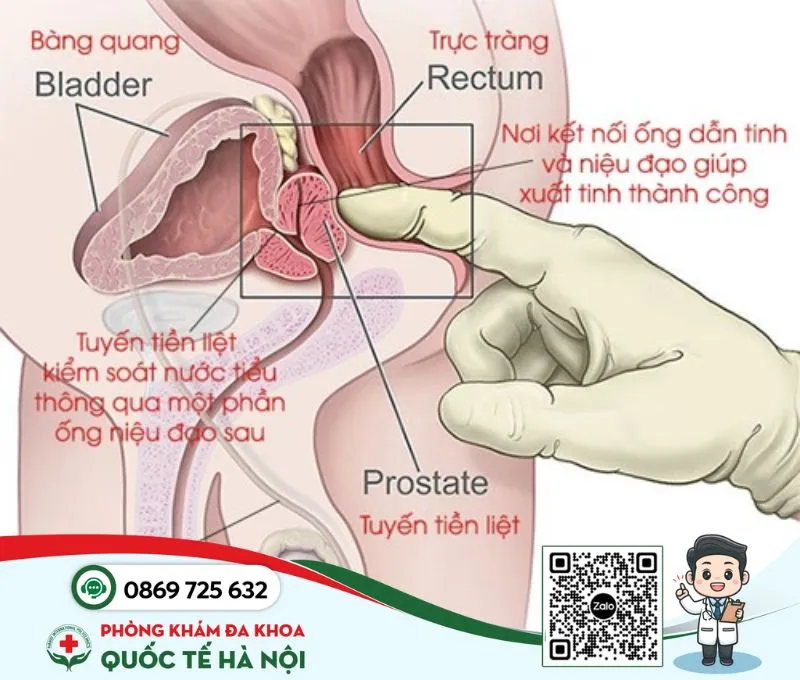 Bệnh nam khoa viêm tuyến tiền liệt