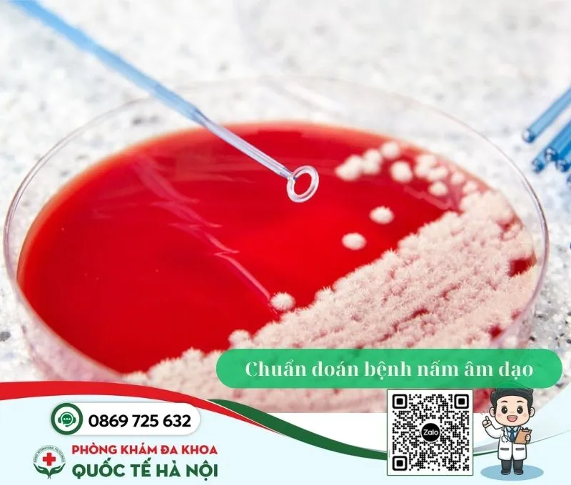 Chuẩn đoán bệnh nấm âm đạo