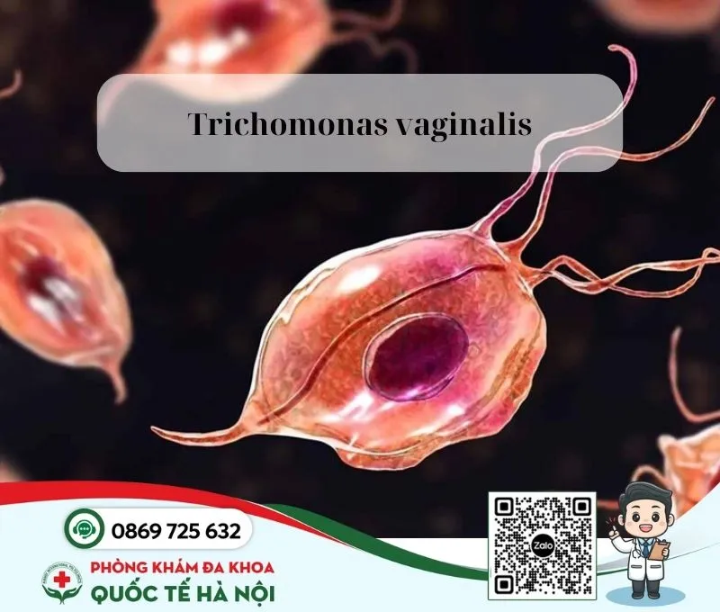 Viêm âm đạo do trùng roi Trichomonas vaginalis