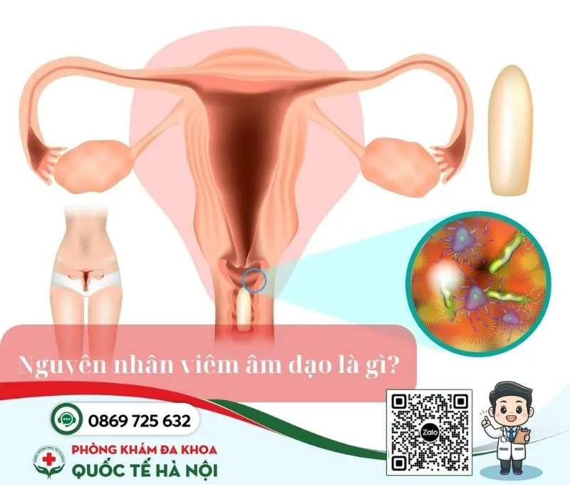 Viêm âm đạo do vi khuẩn