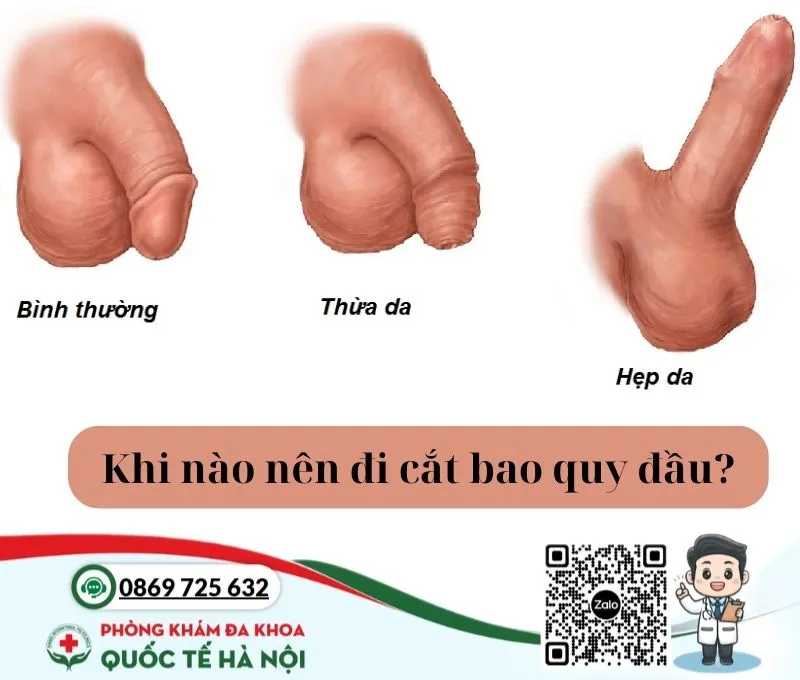 Khi nào nên đi cắt bao quy đầu