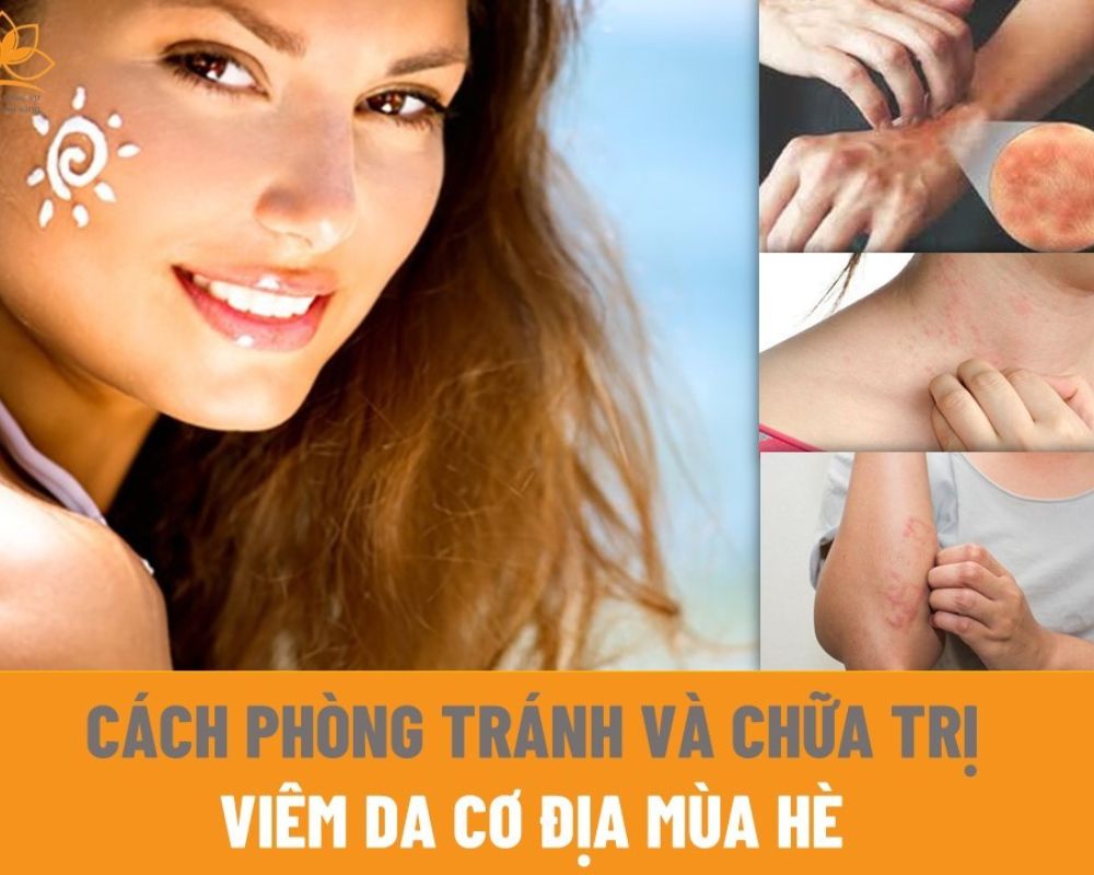 Cách phòng tránh viêm da cơ địa