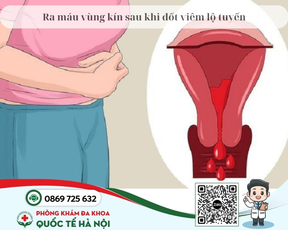 Sau khi đốt viêm lộ tuyến cổ tử cung