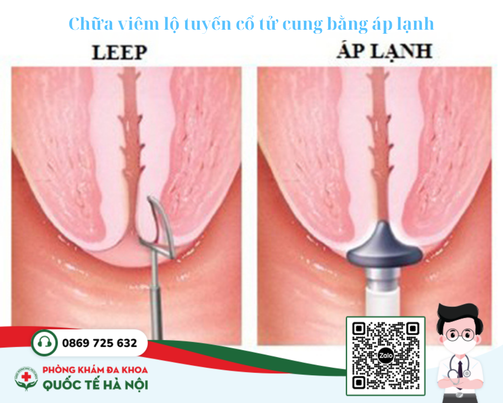 Chữa viêm lộ tuyến cổ tử cung bằng áp lạnh 2