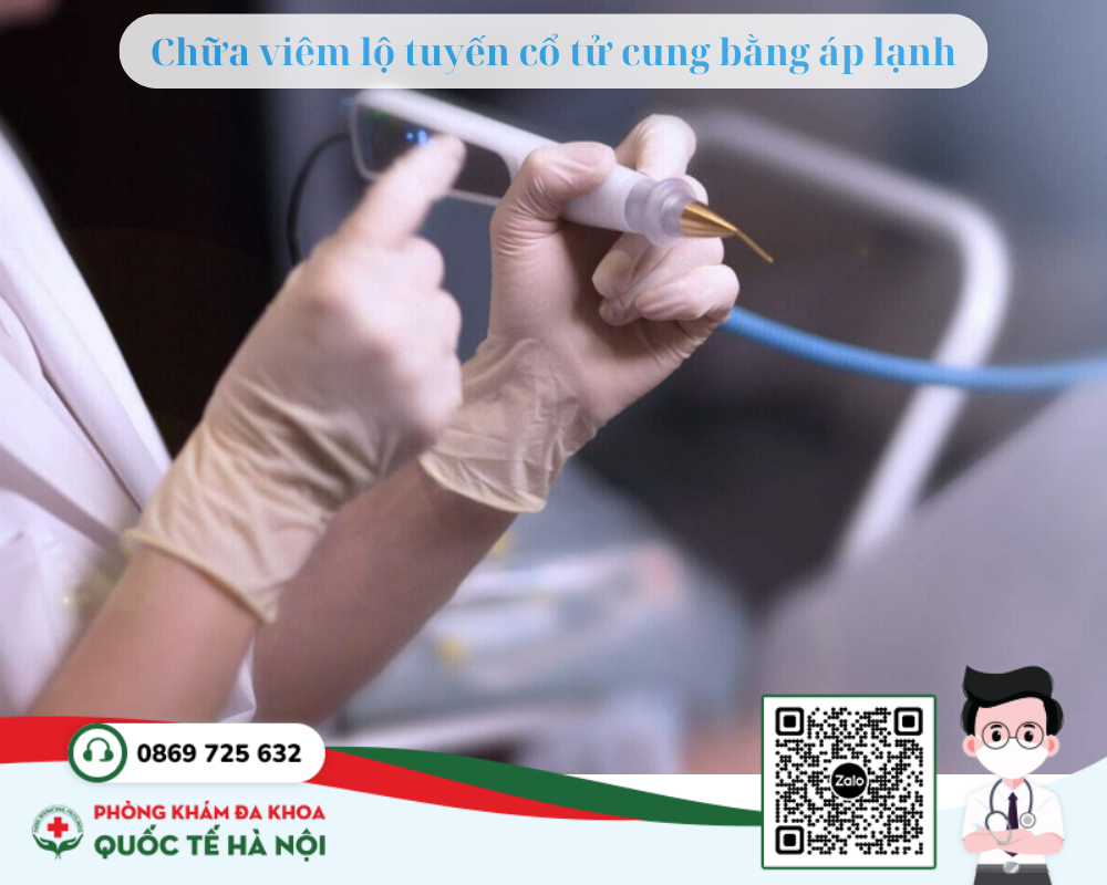 Chữa viêm lộ tuyến cổ tử cung bằng áp lạnh