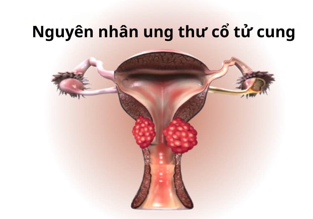 Nguyên nhân Ung thư cổ tử cung