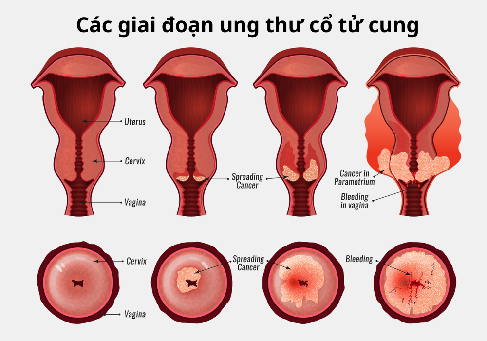 Các giai đoạn ung thư cổ tử cung