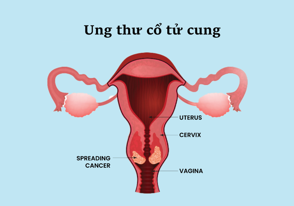 Ung thư cổ tử cung là gì