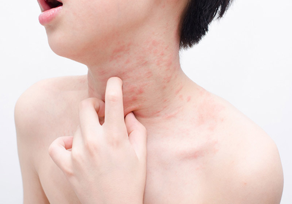Vị trí viêm da dị ứng ở cổ