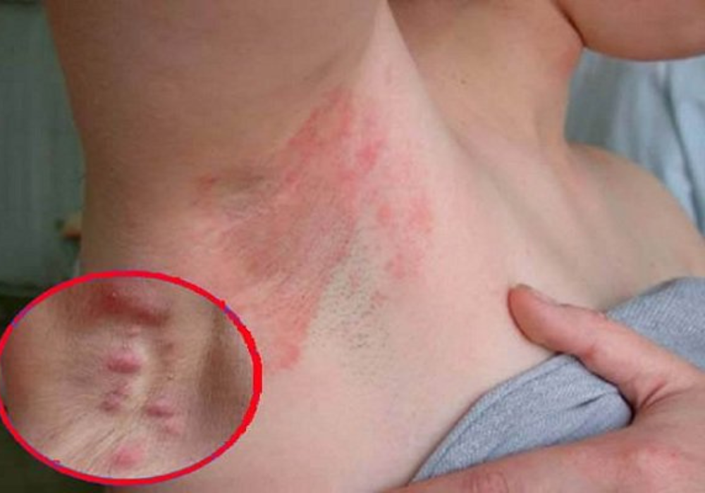 Vị trí viêm da dị ứng ở nách