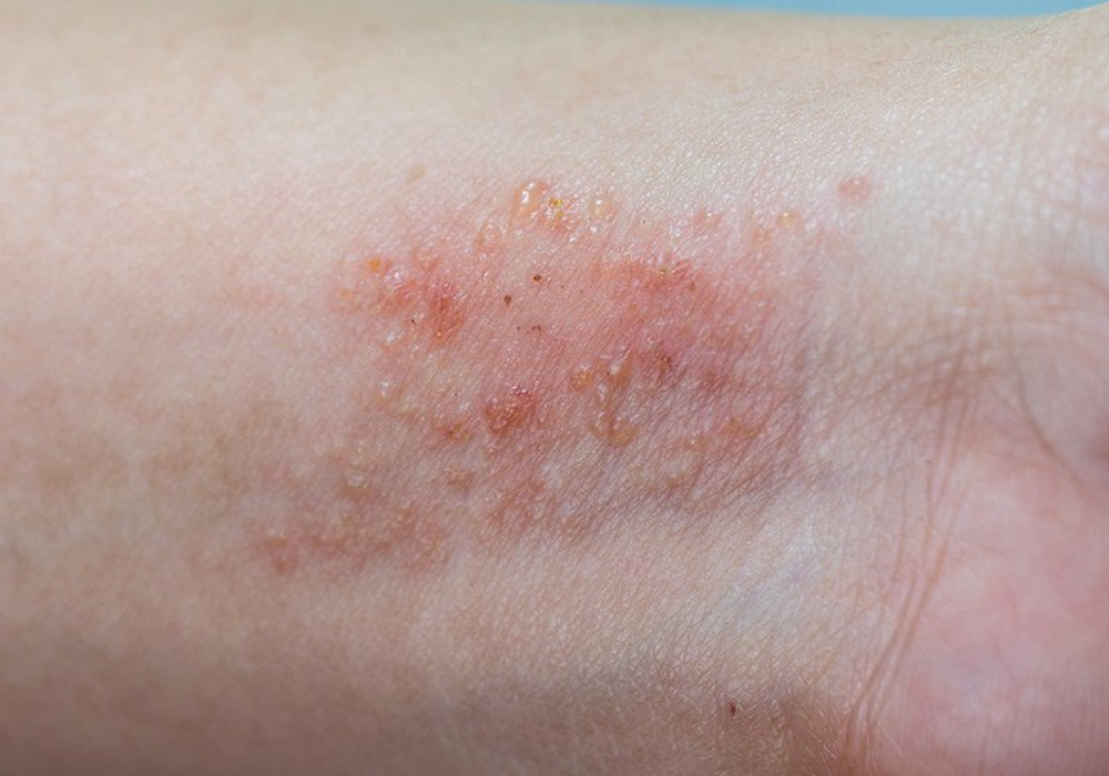 Vị trí viêm da dị ứng