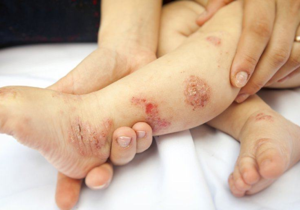 Viêm da cơ địa khi mang thai có lây sang con không
