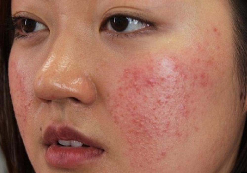 Viêm da dị ứng ở mặt