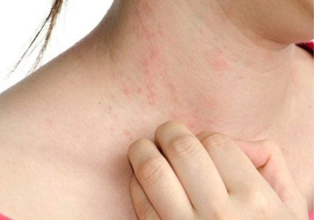 Viêm da dị ứng sau sinh 1