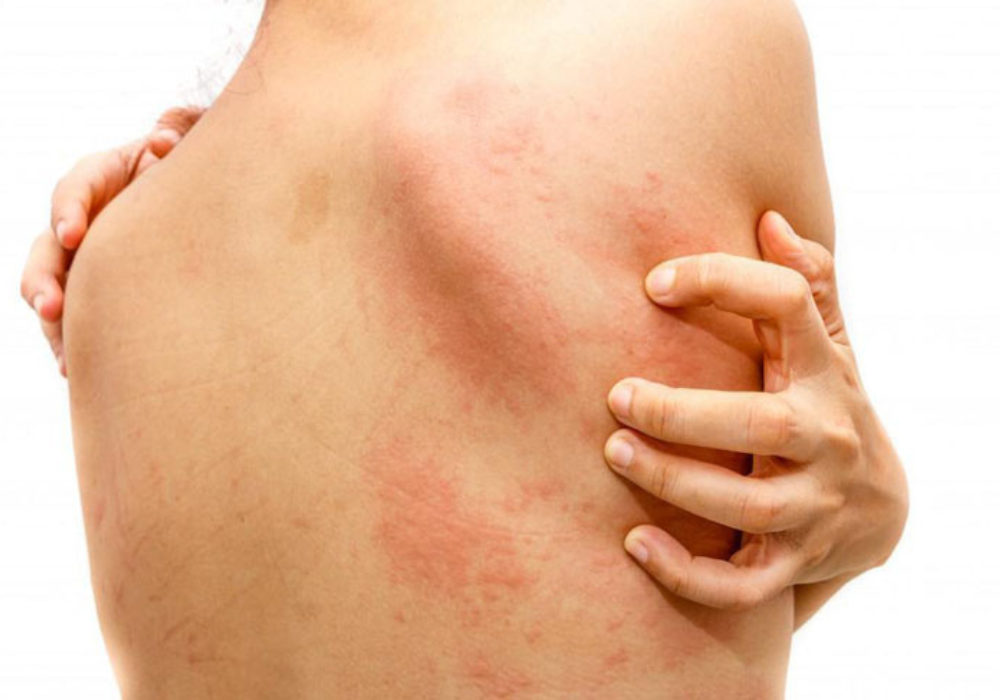 Viêm da dị ứng sau sinh 2