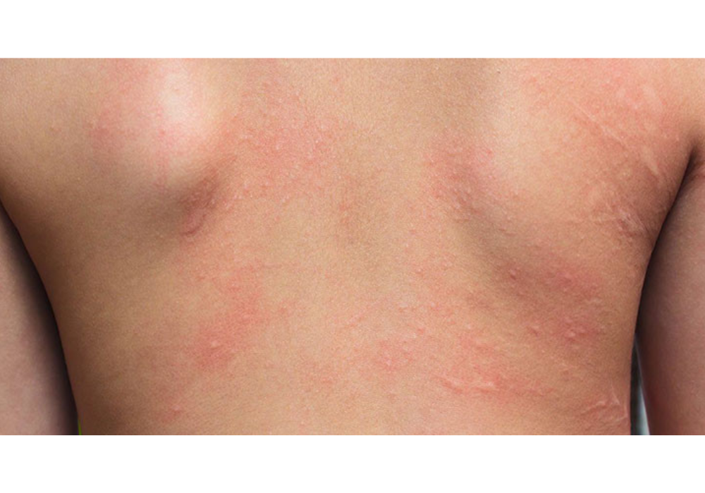 Viêm da dị ứng sau sinh