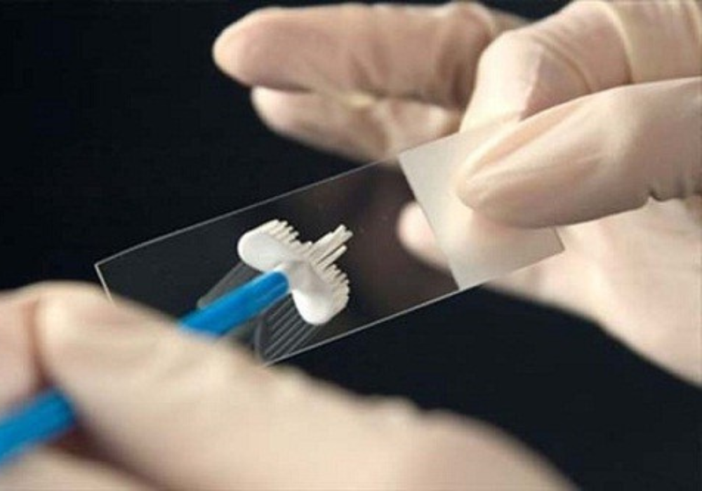 xét nghiệp pap tầm soát ung thư cổ tử cung