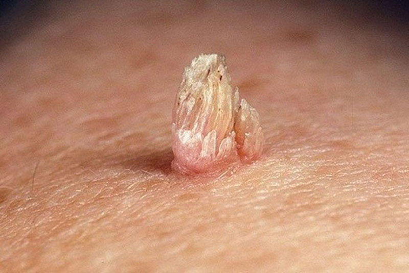 Đa số bệnh nhân đều mắc bệnh sùi mào gà nhẹ.
