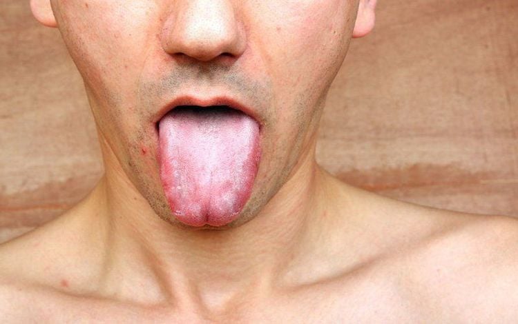 Giang mai có thể biểu hiện ở vùng miệng