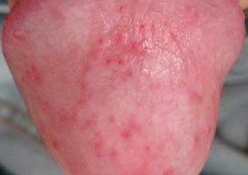  Các loại mụn ở vùng kín do viêm bao quy đầu là một trong các loại mụn ở bộ phận sinh dục nam