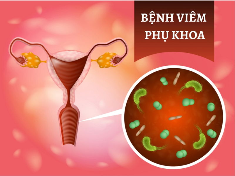 Hình ảnh nổi mụn ở vùng kín nữ có thể là dấu hiệu cảnh báo bệnh phụ khoa