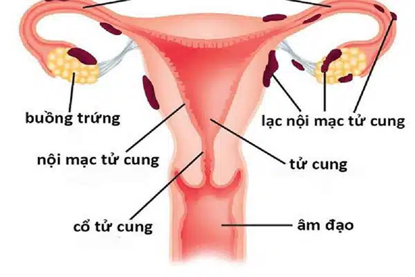 Hình ảnh lạc nội mạc tử cung