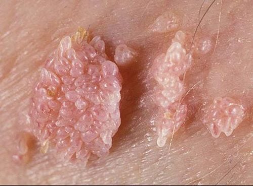  Các loại mụn ở vùng kín do sùi mào gà là một trong các loại mụn ở cơ quan sinh dục