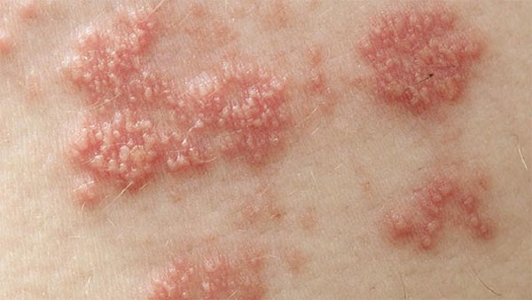 Hình ảnh nổi mụn rộp sinh dục vùng kín nam