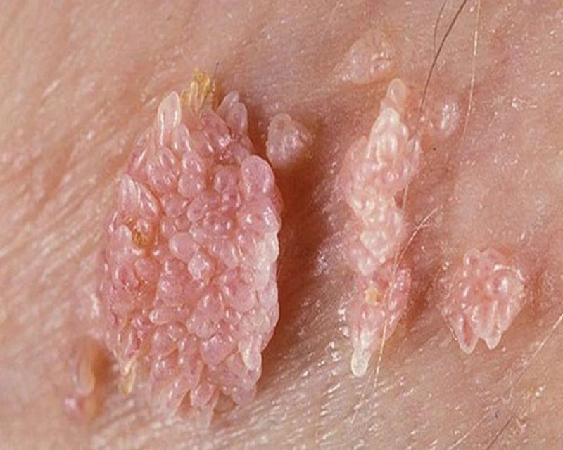Ngứa 2 mép vùng kín có thể do bệnh sùi mào gà