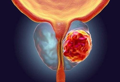 Ung thư tuyến tiền liệt có nguy cơ tử vong cao ở nam giới, chiếm khoảng 2-3% tổng số trường hợp tử vong