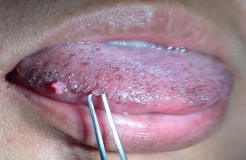 Bệnh sùi mào gà ở miệng do virus HPV gây ra.
